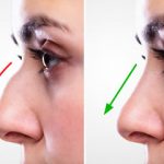 Rhinoplasty