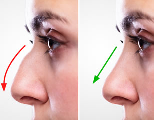 Rhinoplasty