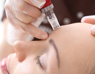 Micro-needling Procedure