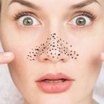 Blackhead Removal Tips