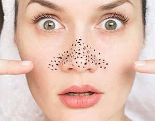 Blackhead Removal Tips