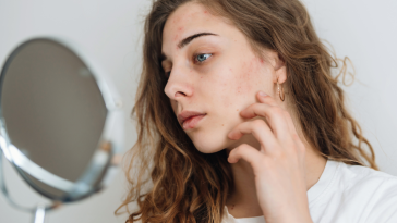 How to Prevent Acne Breakouts for Clear, Healthy Skin